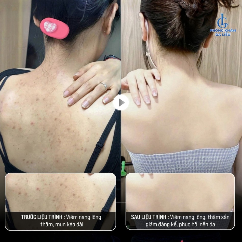 Phác đồ cá nhân hoá kết hợp công nghệ chuyên biệt giúp cải thiện rõ rệt tình trạng viêm nang lông