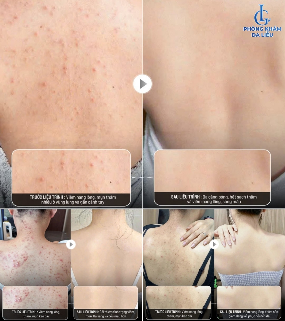 Hiệu quả điều trị mụn lưng và viêm nang lông tại Phòng khám Da liễu LG đã được khách hàng kiểm chứng