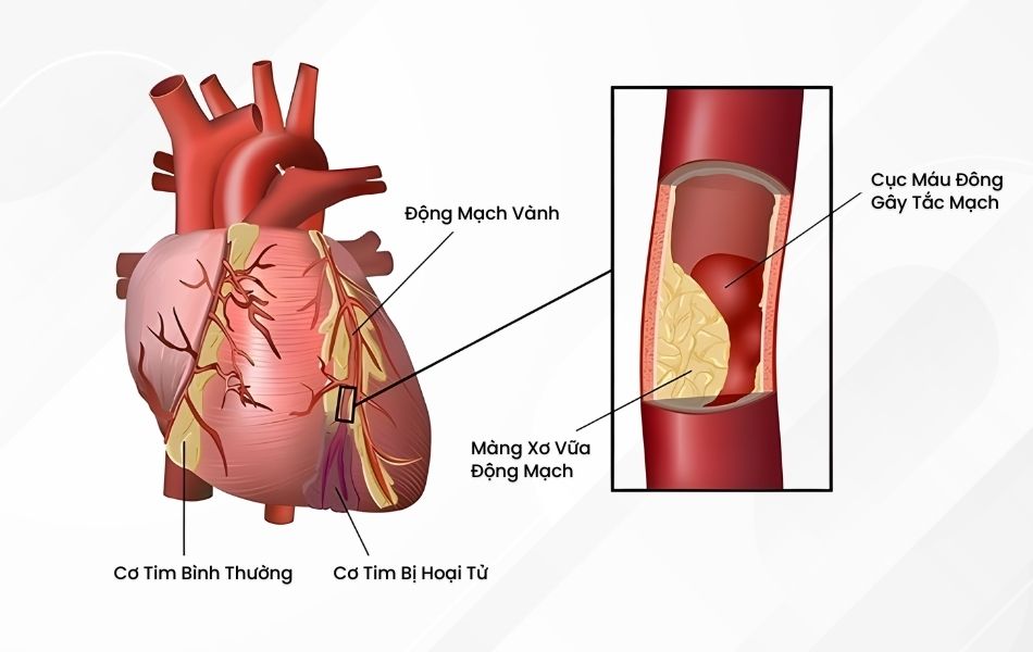 Stress oxy hoá oxy hoá LDL, tạo mảng xơ vữa bám thành mạch
